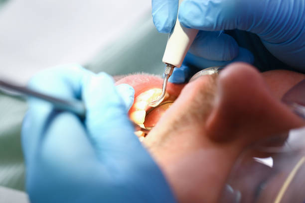 Best Broken or Cracked Tooth Emergency Dentist in North Hornell, NY